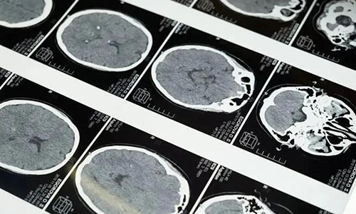 重庆哪家医院治疗癫痫_得了癫痫病如何治疗好?